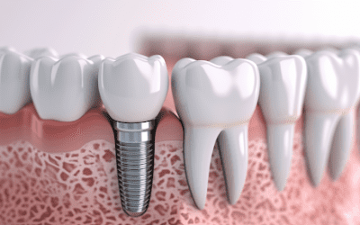 implant dentaire en Turquie