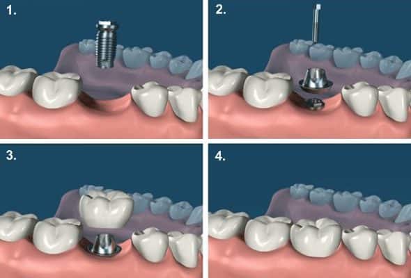 cout implant dentaire