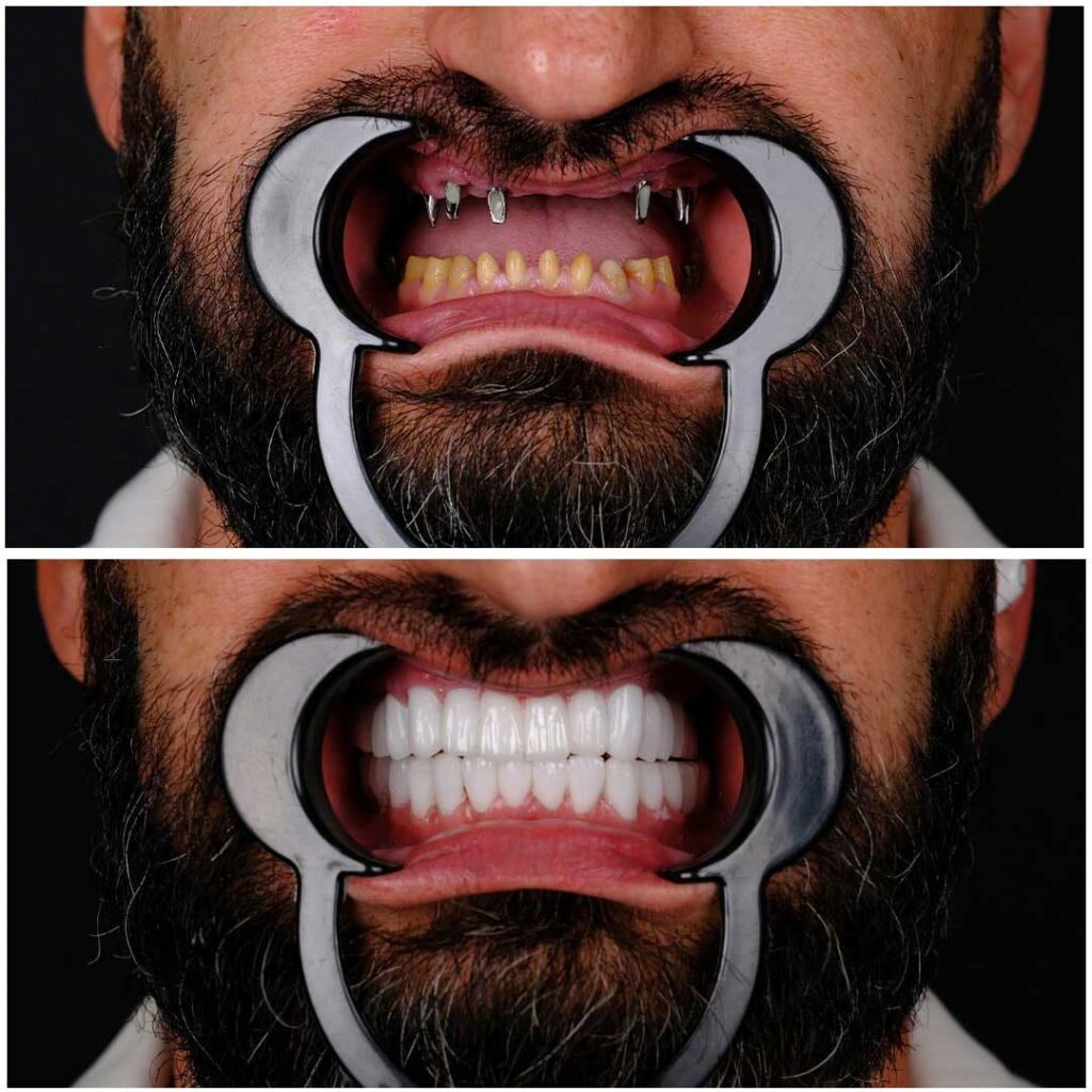 Implant dentaire avant après