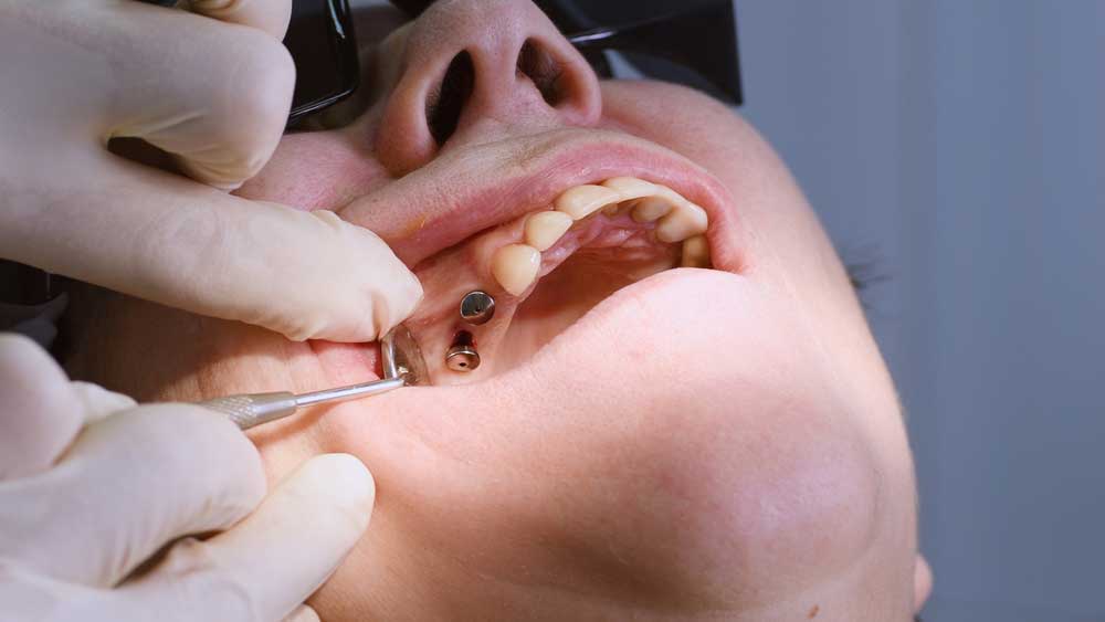 refaire ses dents en turquie prix