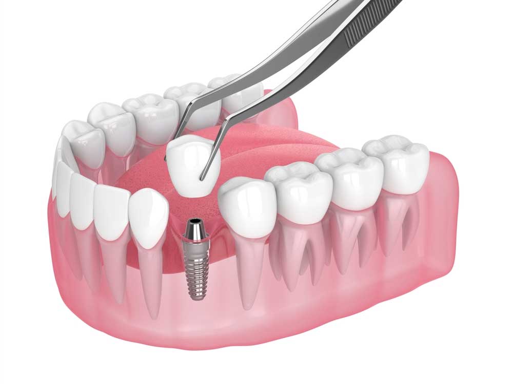 implant dentaire turquie avis