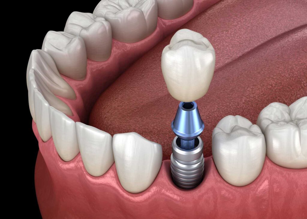 implant dentaire turquie