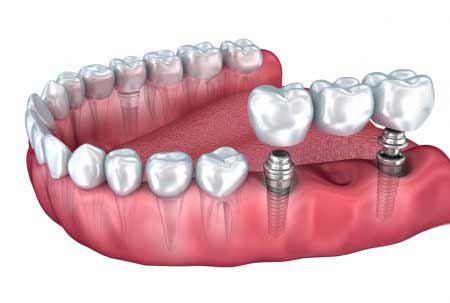 refaire ses dents en turquie