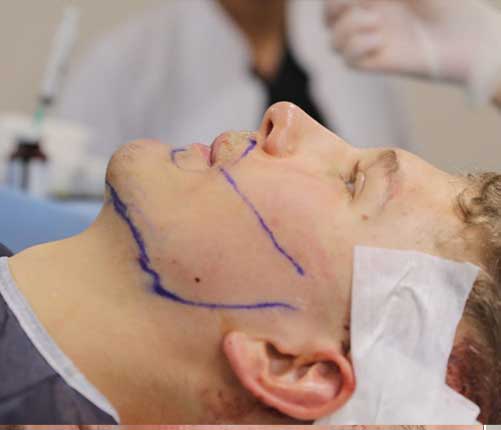 implant de barbe turquie